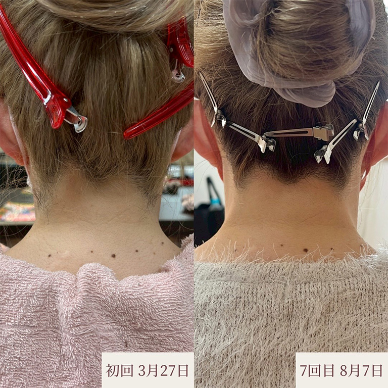 うなじ脱毛 施術例