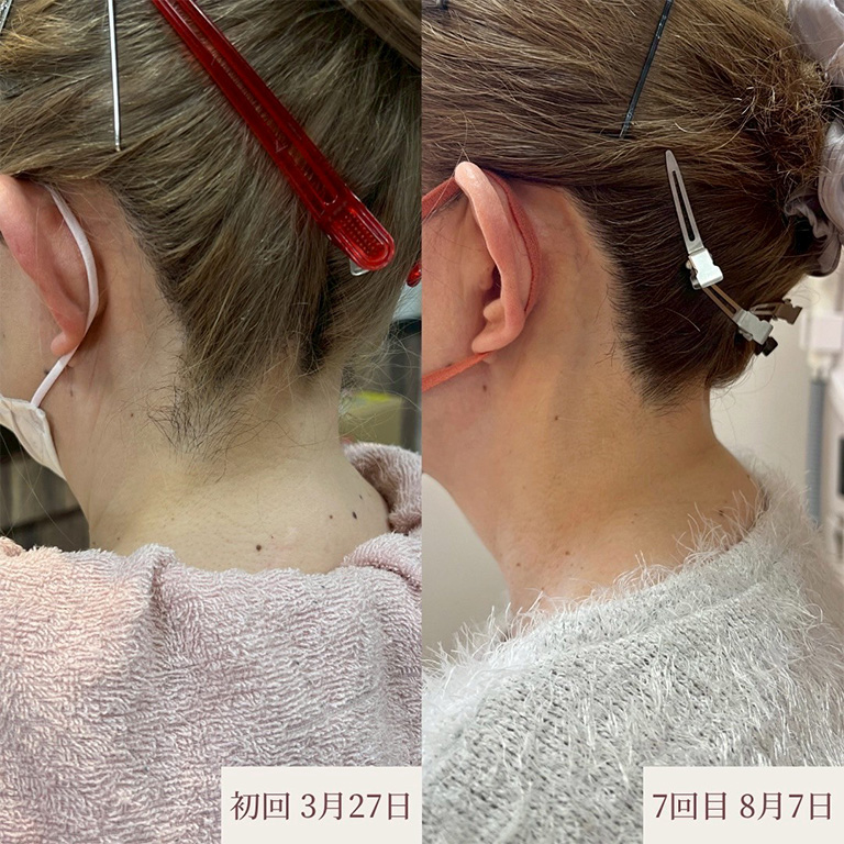 うなじ脱毛 施術例