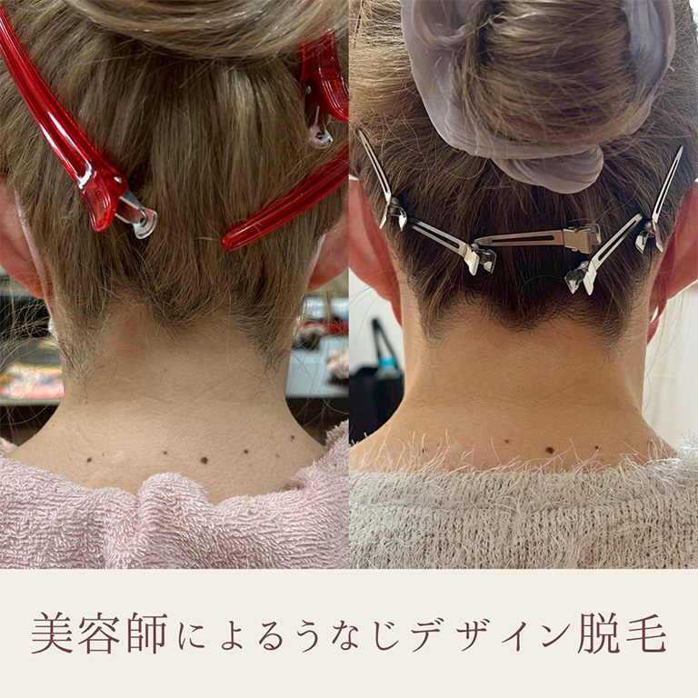 うなじ脱毛 施術例