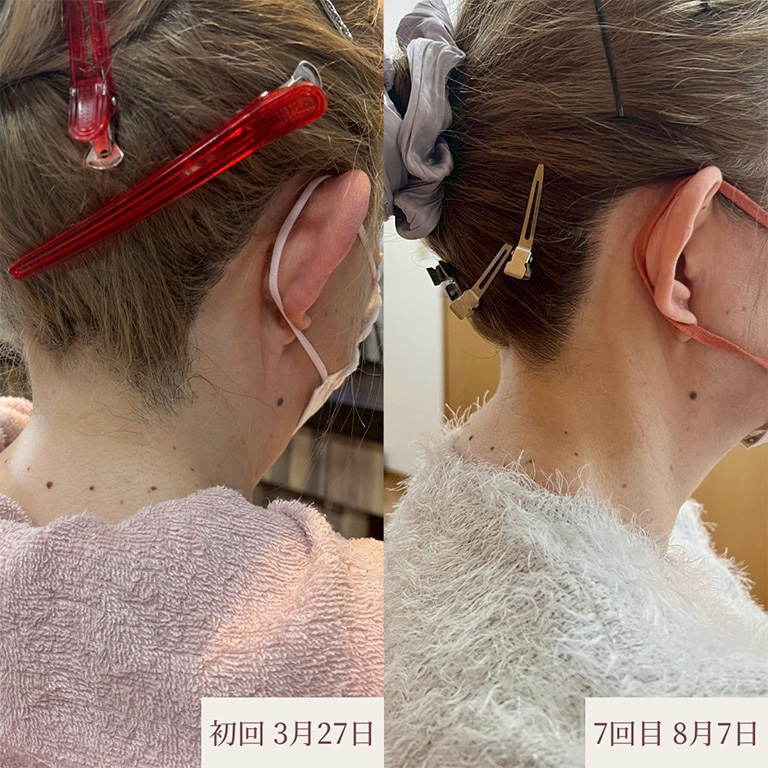 うなじ脱毛 施術例